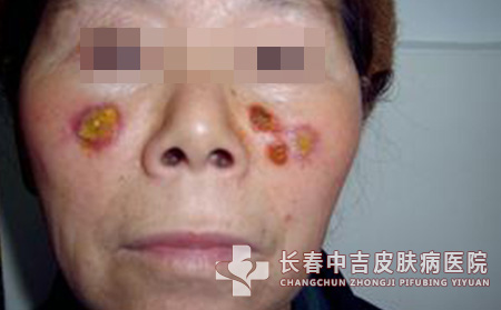 长春治疗红斑狼疮的皮肤病医院