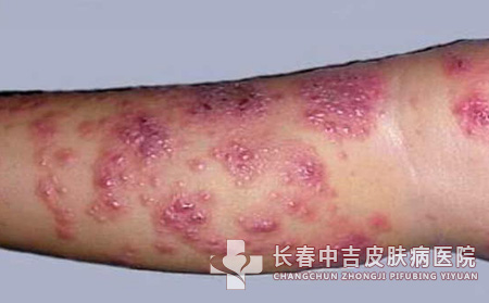皮肤上长疱疹怎么办