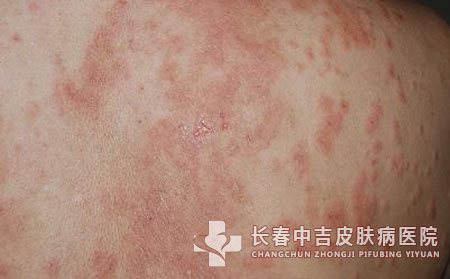湿疹是怎么产生的,湿疹的病因是什么
