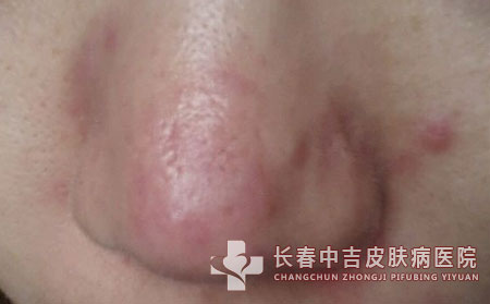 长春酒糟鼻治疗医院