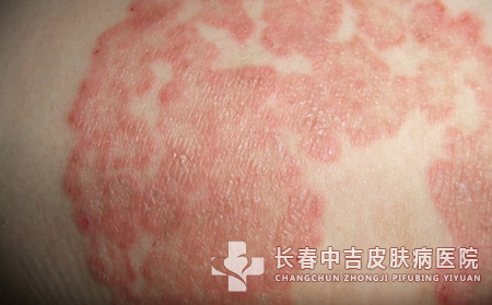 皮炎应该怎么护理