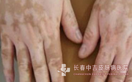 白癜风治疗中的细节有哪些