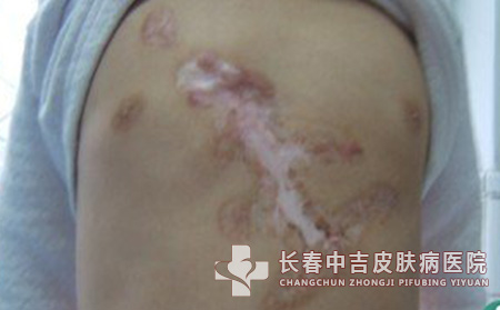 瘢痕患者的饮食禁忌