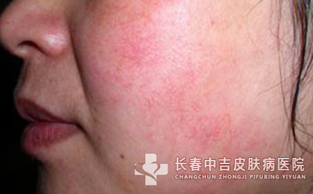 用什么方法能缓解红血丝