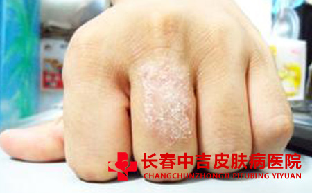 湿疹怎么治疗,如何治疗湿疹