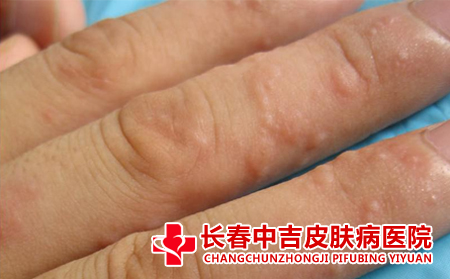 患者应该怎么预防皮炎