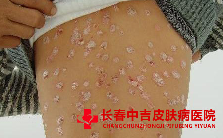 白癜风的诱发因素