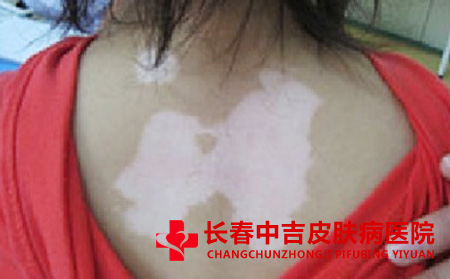 维生素C对白癜风的影响