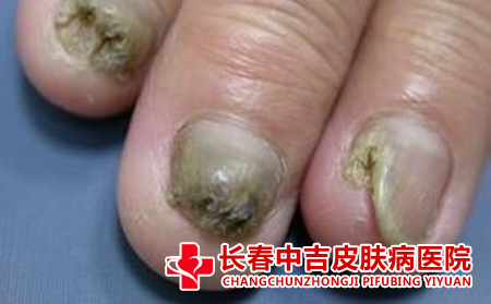 怎么护理灰指甲合适呢