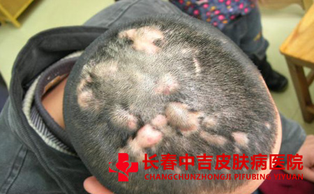头皮上长了毛囊炎要怎么办