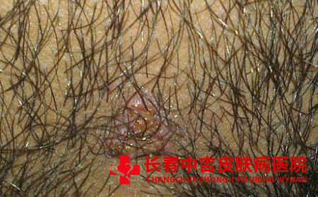 皮肤上面有毛囊炎怎样去除