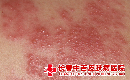 湿疹传染吗,湿疹传不传染,湿疹