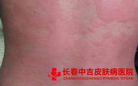 导致荨麻疹患者体质下降的原因