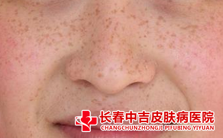 雀斑,护理,雀斑怎么护理