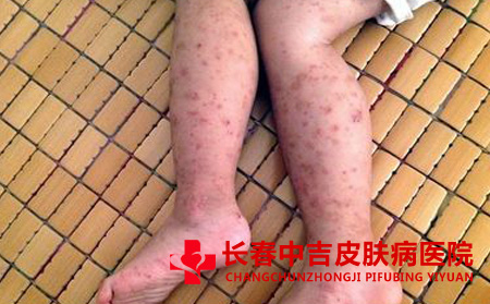 长春荨麻疹治疗医院
