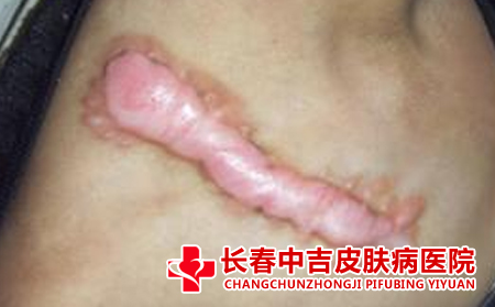 瘢痕在饮食上注意哪些方面