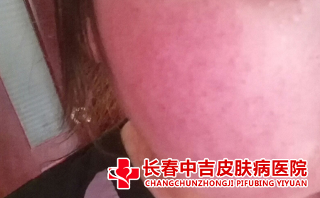 脸上有红血丝用什么方法能改善