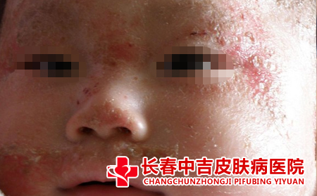 湿疹治疗,湿疹治疗的方法