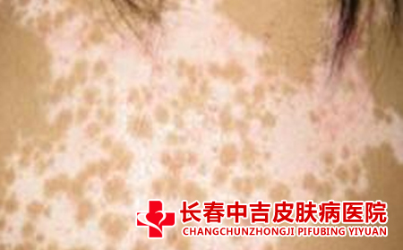 白癜风患者的饮食宜忌