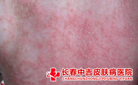 湿疹患者的饮食要注意什么,湿疹