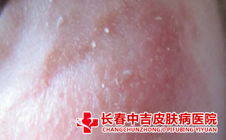 长春皮炎治疗医院