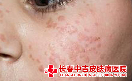 扁平疣治疗的细节有哪些