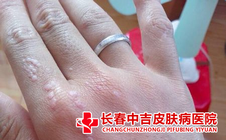 如何护理扁平疣合适呢