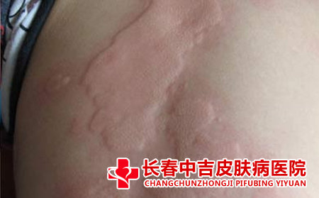 荨麻疹用药