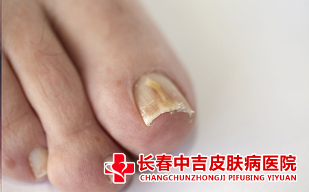 灰指甲的治疗方法