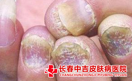 灰指甲护理方法