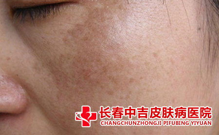 黄褐斑,蜂蜜,蜂蜜淡化黄褐斑