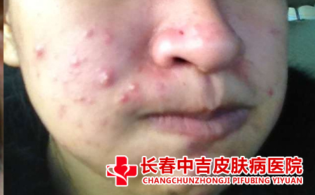 长春治疗痤疮的医院