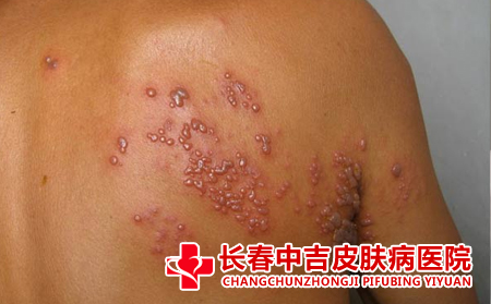 皮肤长了疱疹有什么危害