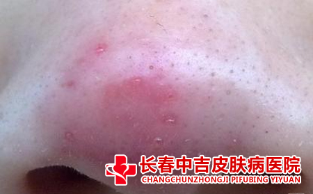 酒槽鼻的预防方式