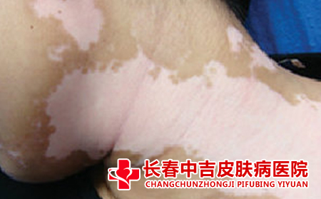 白癜风治疗方法