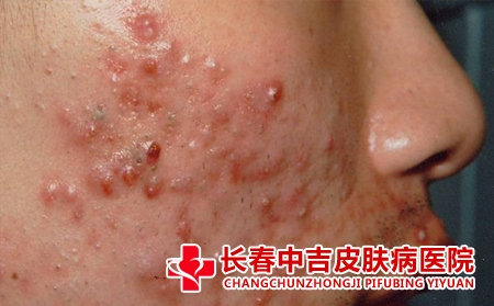 痤疮应该怎么预防