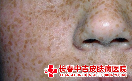雀斑诱发原因是什么