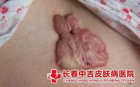 瘢痕护理注意什么