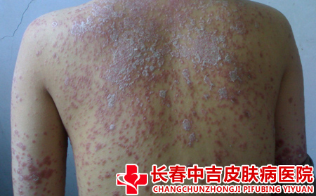 长春治疗牛皮癣的医院