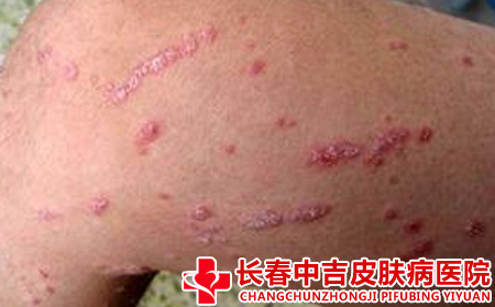 长春治疗牛皮癣的医院在哪里