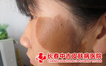 咖啡斑是什么样的