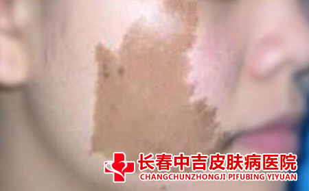咖啡斑能不合适治疗