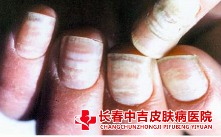 长春去哪里治疗灰指甲