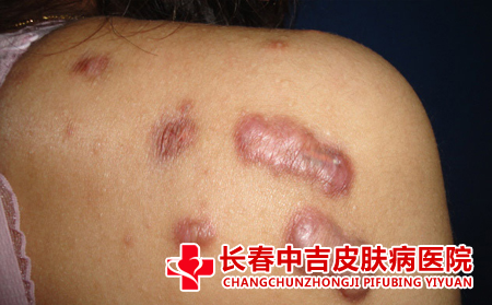 患有瘢痕平时护理怎么做才合适