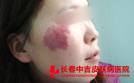 红胎记临床中的发病特点