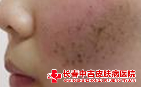 脸上长雀斑怎么办,雀斑