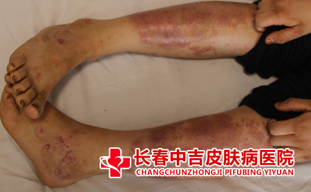 荨麻疹患者应该怎么治疗