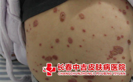 痤疮患者应该怎么护理