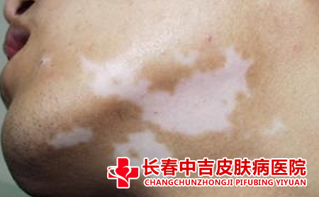为什么白癜风患者不能喝啤酒