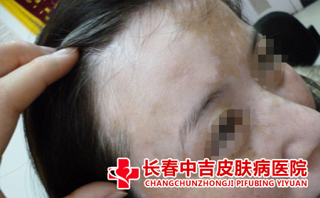白癜风护理的方法